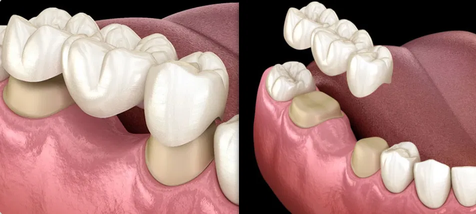 Dental Bridges Calgary