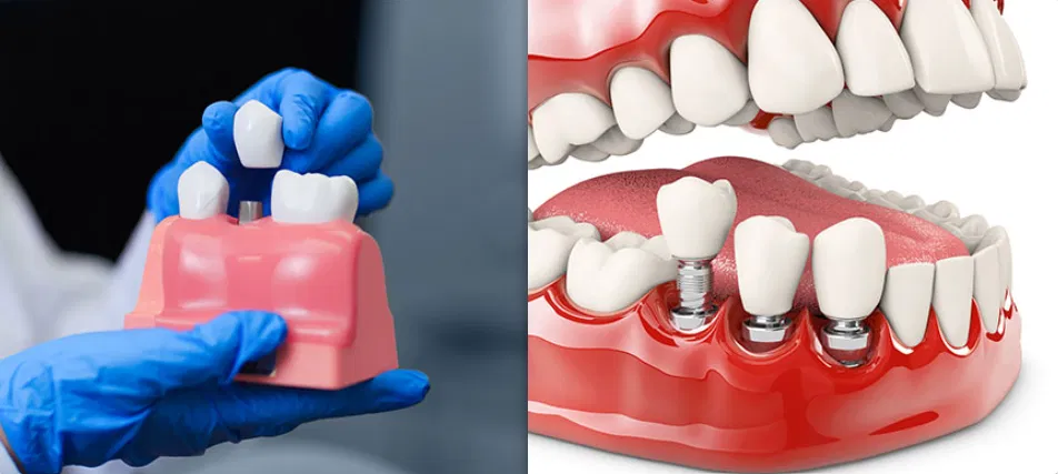 Dental Crowns Calgary