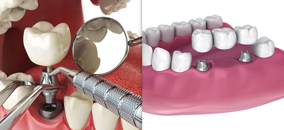 Dental Implants Calgary