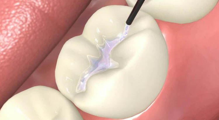 Fissure Sealants Calgary