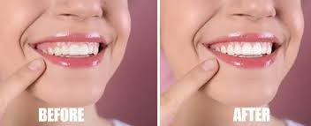 Gum Contouring Calgary