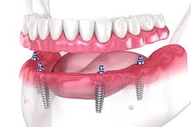 Implant Dentures Calgary