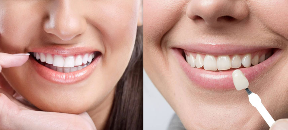 Porcelain Veneers Calgary