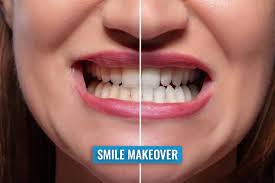 Smile Makeover Calgary