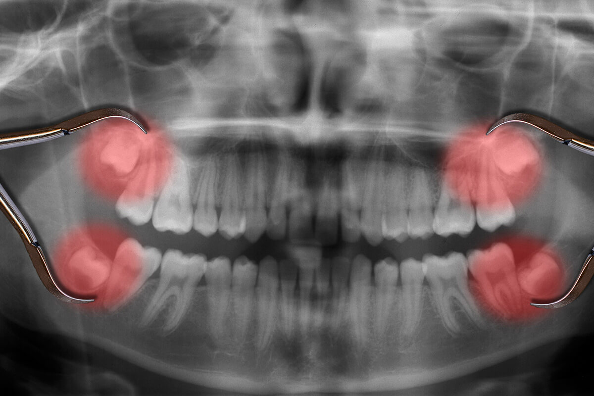 Wisdom Tooth Removal Calgary